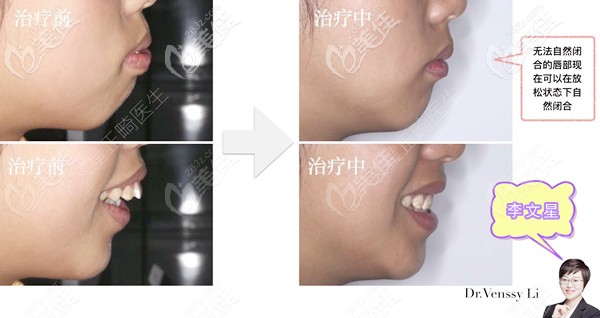 成都牙齒矯正李文星醫(yī)生案例 成都牙齒矯正李文星醫(yī)生案例