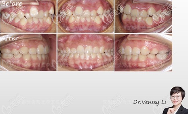 成都比較出名的正畸醫(yī)生李文星等全新整牙案例分享,有地包天和齙牙者速看