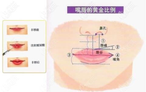 玻尿酸豐唇 玻尿酸豐唇