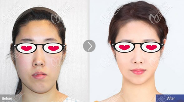 鞋拔子臉矯正前后對比照片 鞋拔子臉矯正前后對比照片