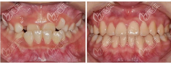 成都茁悅口腔陸開盛院長地包天案例 成都茁悅口腔陸開盛院長地包天案例