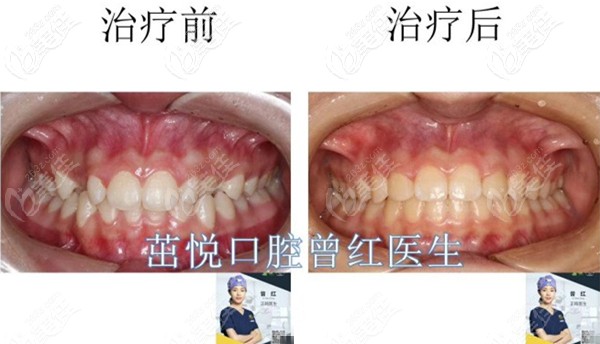 成都茁悅口腔曾紅醫(yī)生的牙列不齊矯正案例 成都茁悅口腔曾紅醫(yī)生的牙列不齊矯正案例