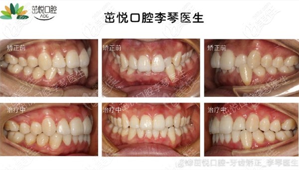 成都茁悅口腔李琴醫(yī)生的深覆合矯治案例 成都茁悅口腔李琴醫(yī)生的深覆合矯治案例