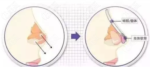 半肋骨膨體隆鼻位置 半肋骨膨體隆鼻位置