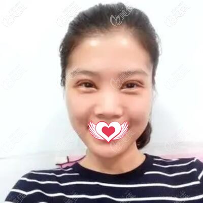 割雙眼皮術(shù)后第3天