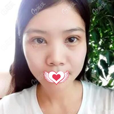 割雙眼皮一周拆線(xiàn)