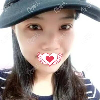 割完雙眼皮術(shù)后近半個(gè)月的恢復(fù)效果照