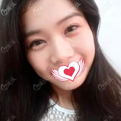 來感受下長沙美萊黃鵬給我做的全切雙眼皮術后2個月恢復效果圖怎么樣？