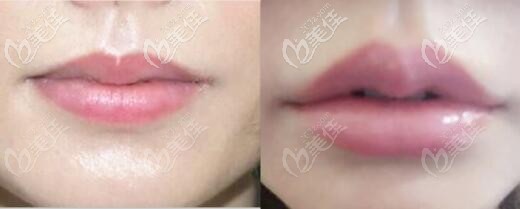 瑞藍(lán)玻尿酸豐唇前后對(duì)比效果照 瑞藍(lán)玻尿酸豐唇前后對(duì)比效果照