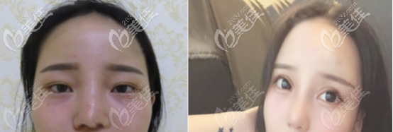 玻尿酸隆鼻案例