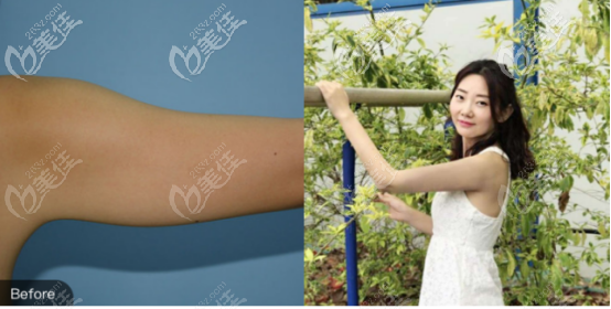 手臂吸脂對比照片 手臂吸脂對比照片