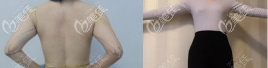 手臂吸脂對比圖片 手臂吸脂對比圖片