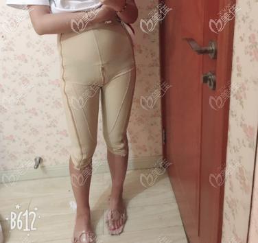 濟南寶琳娜大腿吸脂第五天