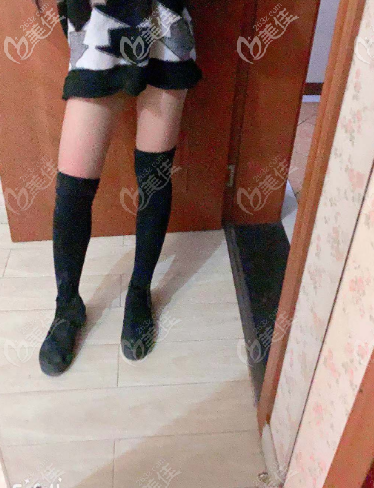 如果你問我濟南哪家醫(yī)院做吸脂好？請參考寶琳娜大腿吸脂術(shù)前術(shù)后對比圖