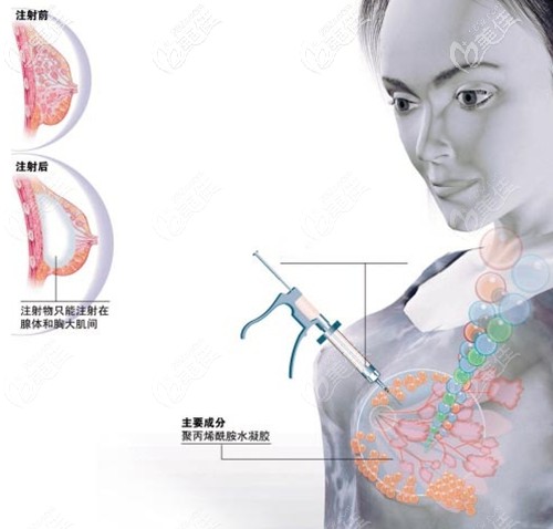 廣州海峽是廣州專門取胸部奧美定的醫(yī)院