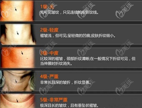 頸紋的程度