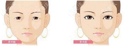 眼綜合效果對(duì)比