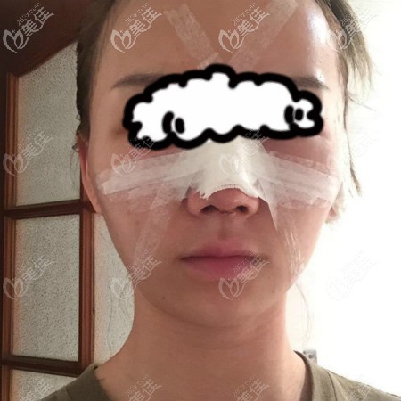 我找武漢美基元汪福強做鼻子術(shù)后第3天