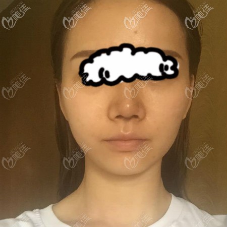 美基元汪福強給我做肋骨鼻綜合術(shù)后十天效果圖片