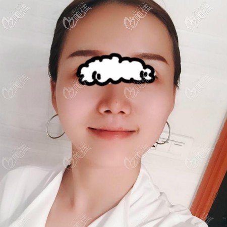 我在武漢美基元做肋骨鼻綜合手術(shù)2個月效果圖片