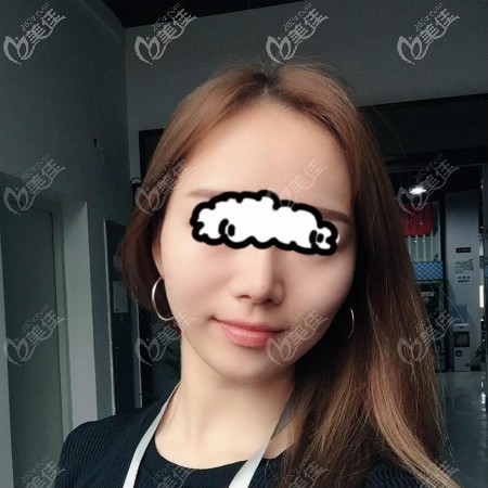全面對比后,在武漢美基元找汪福強醫(yī)生做了肋骨鼻加膨體隆鼻綜合手術