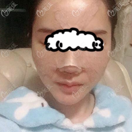 壹加壹李艷東給我做肋骨鼻術(shù)后第2天樣子