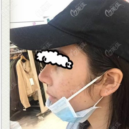 壹加壹李艷東為我做半肋骨隆鼻手術(shù)拆線后效果圖片