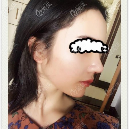 我找武漢壹加壹李艷東做鼻子術(shù)后半個(gè)月效果