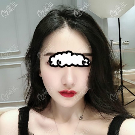 壹加壹李艷東隆鼻案例：肋骨鼻2個(gè)月恢復(fù)效果圖片