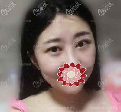 祛眼袋半個月的恢復(fù)效果照 祛眼袋半個月的恢復(fù)效果照