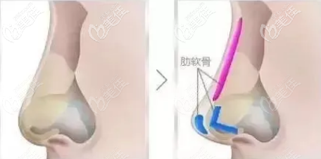 全肋骨隆鼻手術(shù)部位 全肋骨隆鼻手術(shù)部位