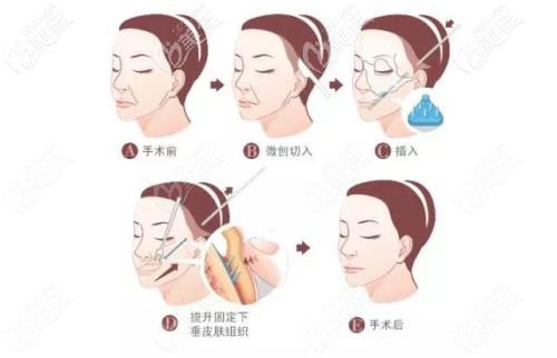 面部埋線的部位