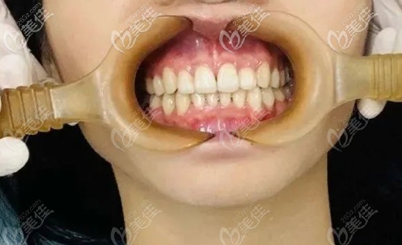 齒科正畸案例-為了做牙齒矯正拔了四顆4號牙,打了兩顆支抗釘...