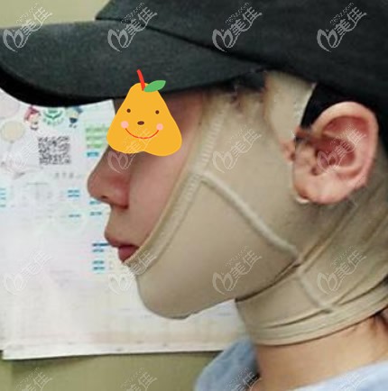 面部吸脂后帶頭套能預(yù)防凹凸不平