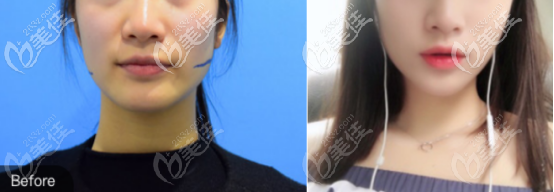 下頜角切除一個月的術(shù)前術(shù)后對比照片 下頜角切除一個月的術(shù)前術(shù)后對比照片