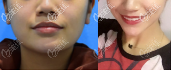 下頜角切除一個月的術(shù)前術(shù)后對比照片 下頜角切除一個月的術(shù)前術(shù)后對比照片