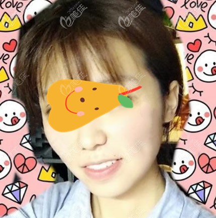 臉部抽脂7天<span style=