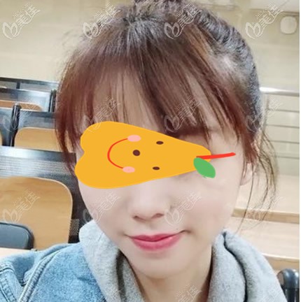 從我面部吸脂恢復(fù)一周過程圖片看,蘭州時(shí)光相伴整形醫(yī)院趙梅霞醫(yī)生臉部抽脂技術(shù)挺靠譜呀!