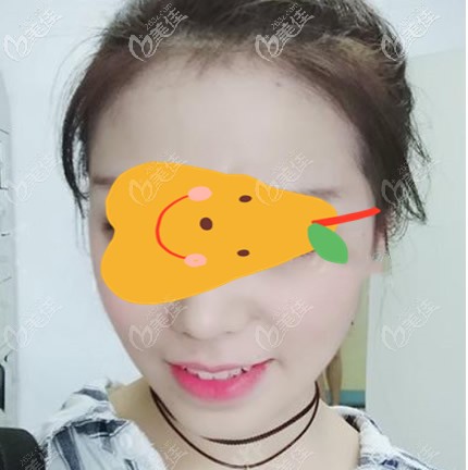 面部吸脂做完10天圖片