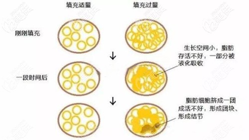 在術(shù)后脂肪填充過量會導(dǎo)致液化結(jié)節(jié)