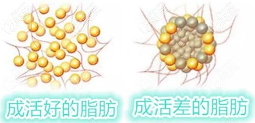 成活好的脂肪和成活差的脂肪對比
