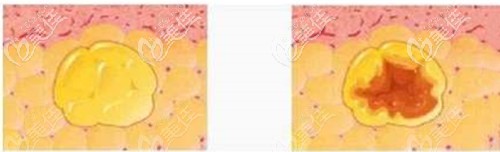 為啥脂肪填充后會出現(xiàn)液化