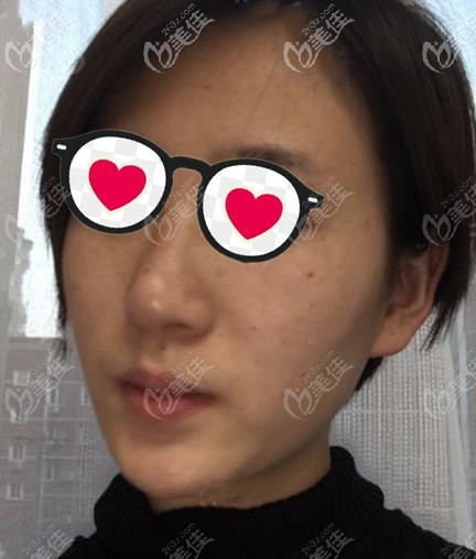 蘭州時光相伴整形醫(yī)院美國755蜂巢皮秒激光祛斑前 蘭州時光相伴整形醫(yī)院美國755蜂巢皮秒激光祛斑前