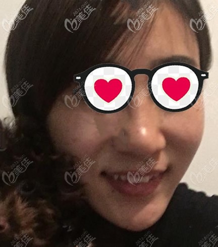 蘭州時光相伴黃國棟激光祛斑第三天<span style= 蘭州時光相伴黃國棟激光祛斑第三天<span style=