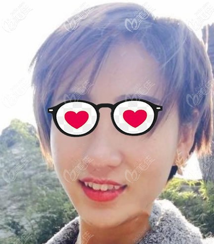 皮秒祛斑10天變化圖片 皮秒祛斑10天變化圖片