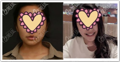 厚唇整m唇手術(shù)后六個(gè)月效果圖片 厚唇整m唇手術(shù)后六個(gè)月效果圖片