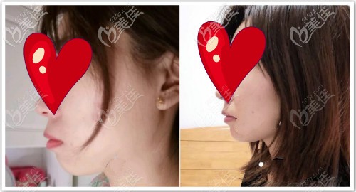 我骨性反頜做正畸+正頜手術(shù)恢復(fù)半年效果圖片 我骨性反頜做正畸+正頜手術(shù)恢復(fù)半年效果圖片