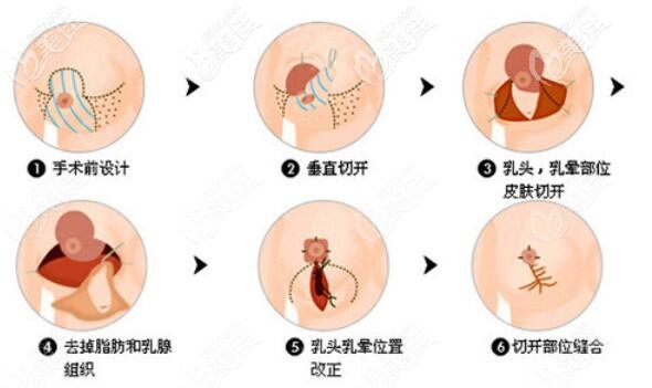 垂直雙蒂切開(kāi)法縮胸介紹 垂直雙蒂切開(kāi)法縮胸介紹