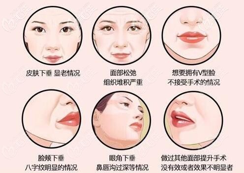 面部埋線提升適合人群