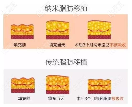 納米脂肪和傳統(tǒng)脂肪效果的對比 納米脂肪和傳統(tǒng)脂肪效果的對比